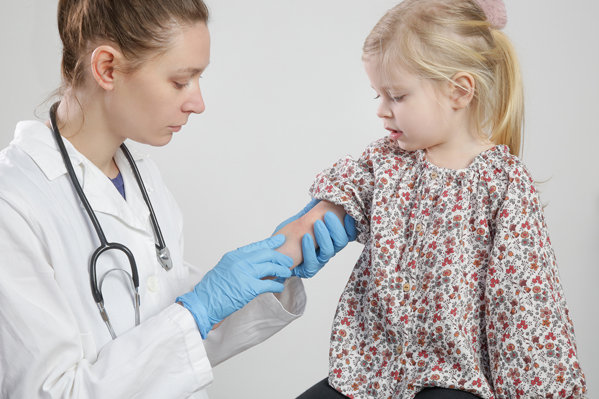 Doença comum na infância, a dermatite atópica atinge 2 em cada 10 crianças com menos de 5 anos