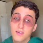 Jovem acordou com olhos inchados — Foto: Reprodução/TikTok