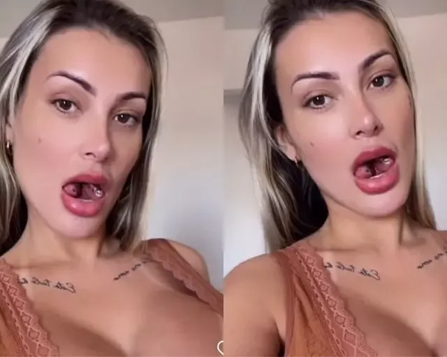 A criadora de conteúdo adulto Andressa Urach após cirurgia para bifurcação de sua língua – Foto: Reprodução